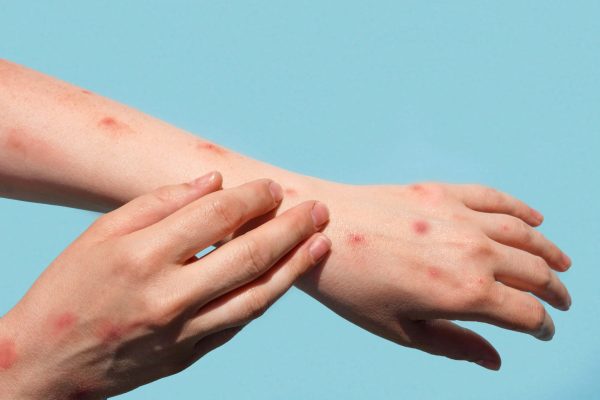 arm-with-mpox-rash